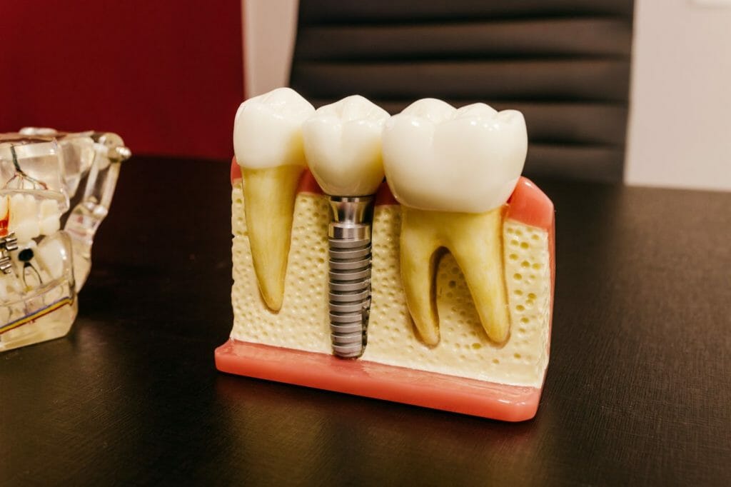 Why Dental Implants May Be Right for You