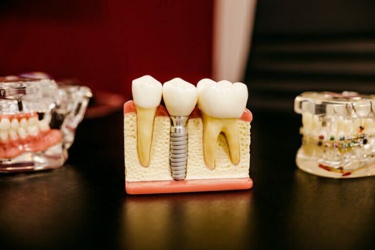 6 Remarkable Health Benefits of Dental Implants