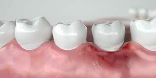 What is the Best Treatment for Gum Disease